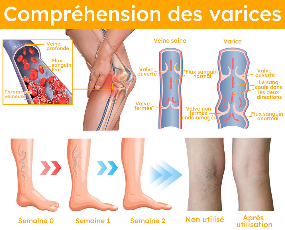 Spray Contre Les Varices Au Venin D'abeille